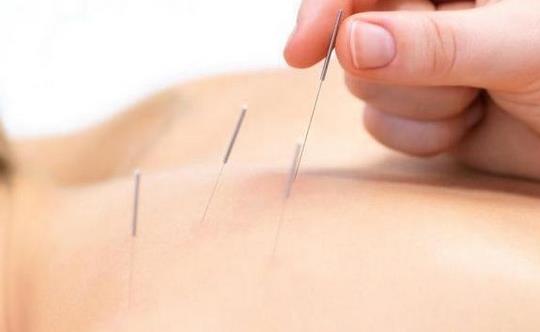 針灸減肥別信這些誤區