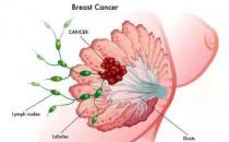 乳腺纖維瘤能不能治好？乳腺纖維瘤三級嚴重嗎