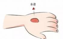 ?燙傷的水泡能挑破嗎 科學(xué)處置燒燙傷方法