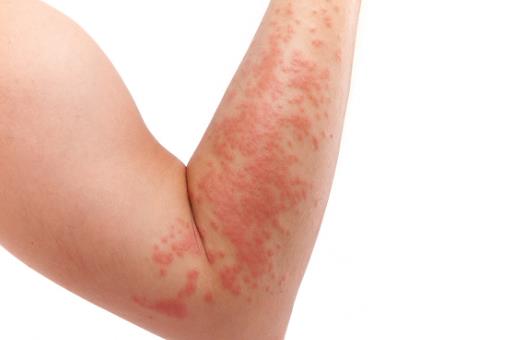 春季易引發的皮膚病 幾種方法助你輕松應對