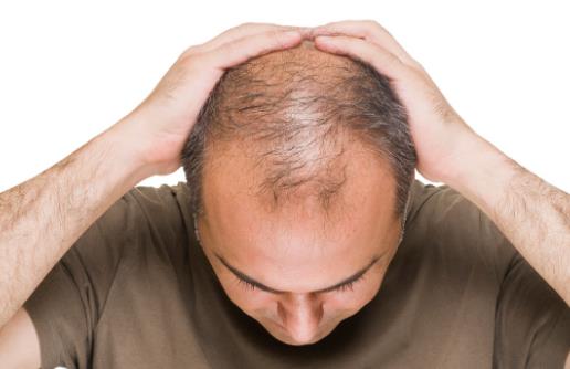 這些行為容易導(dǎo)致脫發(fā) 要及時(shí)改正