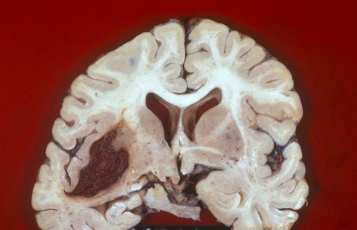 腦出血發生前兆的癥狀 保持心情舒暢預防腦出血