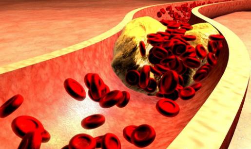 血管變硬竟然是猝死的信號 3步做好動脈硬化的防治