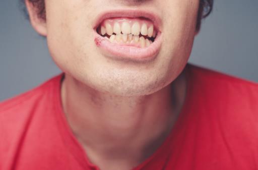 為什么會長唇部皰疹 唇部皰疹怎么治療