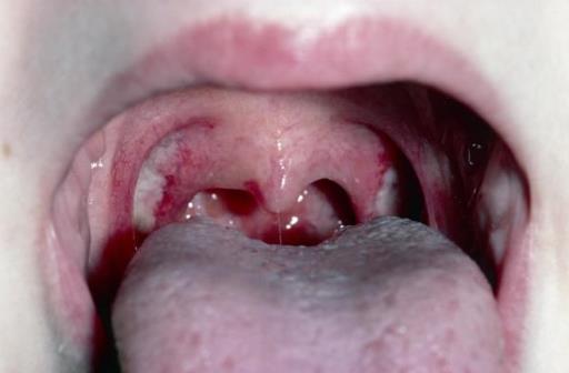 扁桃體結石需要安全護理 扁桃體結石形成原因及危害