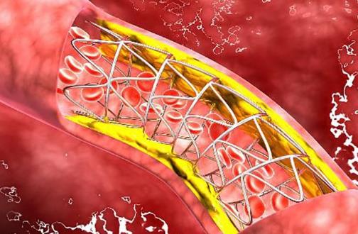 人到40歲血管易堵 吃什么可以清血管