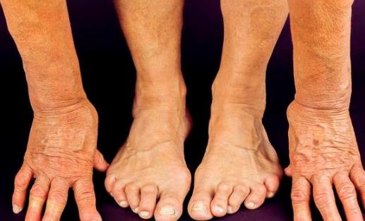 類風濕患者越吃越健康的東西的天然療效，