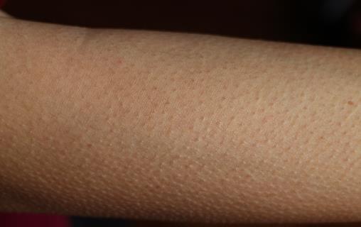 消除“雞皮疙瘩”,讓皮膚恢復光滑