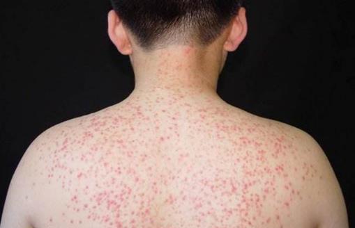 消除“雞皮疙瘩”,讓皮膚恢復光滑