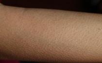 皮膚不平整總起雞皮疙瘩 教你消雞皮讓皮膚恢復光滑