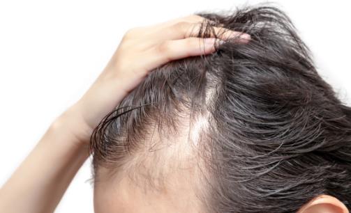 年輕人脫發(fā)嚴(yán)重 如何讓頭發(fā)濃密