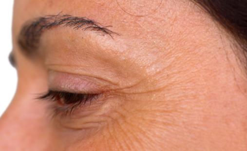 擋不住的魚尾紋幫你有效應對 去魚尾紋的小偏方大全