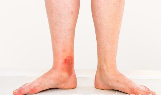 淤血體質調理食物有效祛瘀