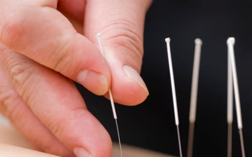 針灸減肥遠離6誤區針灸減肥的穴位常用