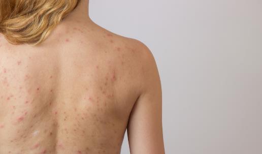 后背成長痘重災區 背后長痘的解決措施及預防方法