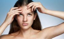 痘痘的調理不能盲目進行 10個民間快速有效祛痘小偏方 