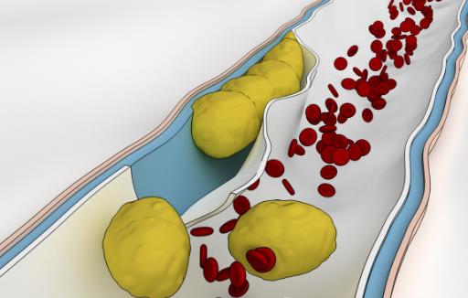 血栓是怎么形成的？如何遠離血栓？