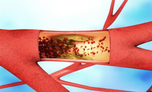 血栓是怎么形成的？如何遠離血栓？