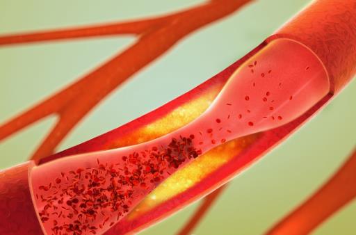 血栓是怎么形成的？如何遠離血栓？