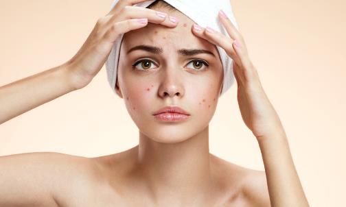 預防青春痘的4個方法