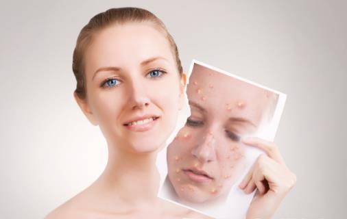 辣椒無辜背鍋!營養(yǎng)學專家說,長痘的“真兇”是這三種食