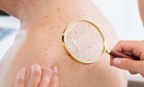 皮膚高度過敏怎么保濕 方法在這里