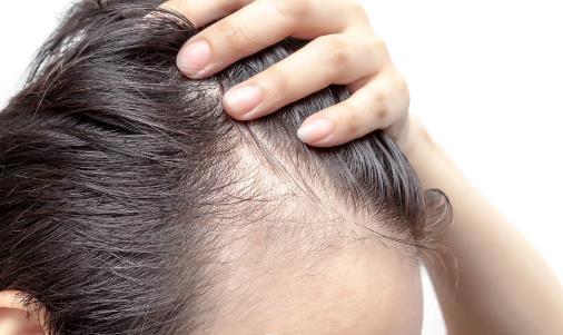 頭發(fā)少要怎么保養(yǎng)?四個(gè)問(wèn)題要注意