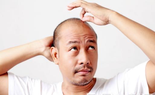 脫發或是疾病引起 防止脫發的最佳六大方法