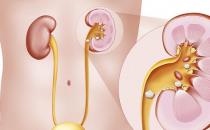 腎結石出現的六大原因 預防腎結石復發的飲食調理