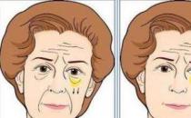 北京彤美整形醫院劉風卓眼整形怎么樣