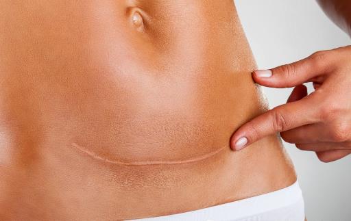 剖腹產(chǎn)的傷口,我該拿你怎么辦