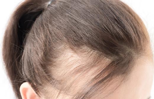 有種產后煩惱叫一薅一把毛 為什么掉發找上產后新媽