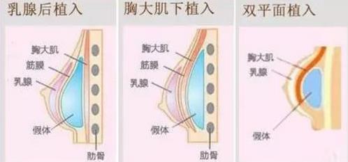 北京韓嘯醫生:為什么假體隆胸手術之后胸部疼痛