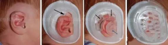 新生兒耳廓畸形能矯正嗎?看成都民生耳鼻喉醫(yī)院如何支招