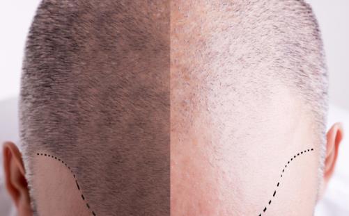 當代壓力大脫發的人越來越多 冬日防禿的日常妙招