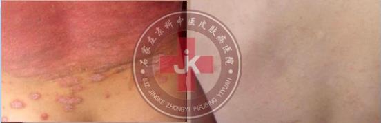 許光生:多年兒童牛皮癬終于治好,兒童牛皮癬怎么治