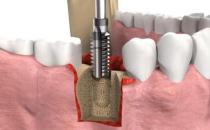 武漢做種植牙多少錢，種植牙品牌改如何選擇？