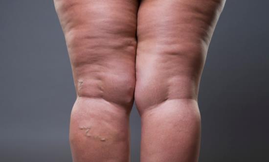 總是吃太咸的食物易引發水腫 吃得太咸還會引發什么疾病