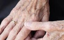 老年斑并不是老年人的專利 預防和延緩老年斑發生的食物