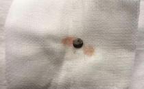 普瑞眼科取出患者眼內5毫米金屬，保住眼球