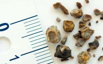 【尿結石】尿結石怎么引起的_尿結石癥狀及最佳治療方法_尿結石和腎結石的區別 【尿結石】尿結石怎么引起的_尿結石癥狀及最佳治療方法_尿結石和腎結石的區別