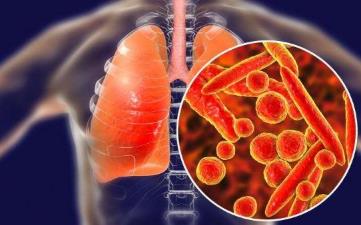 【新型冠狀病毒肺炎】新冠病毒感染肺炎早期癥狀、潛伏期、預防、治療