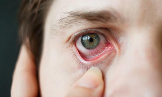 紅血絲青睞眼部和臉上 要怎么有效擺脫？