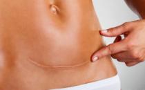 ?細數剖腹產的七大危害 剖腹產坐月子注意事項