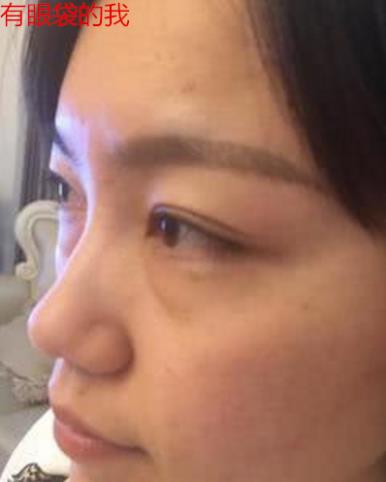 衛婭日記：我一直都以為眼袋對我的影響只是美觀，直到我了解了以后……