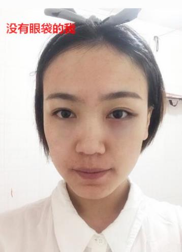 衛婭日記：我一直都以為眼袋對我的影響只是美觀，直到我了解了以后……