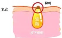 甲硝唑凝膠去黑頭要看主流，別拿個(gè)體差異混淆視聽(tīng)