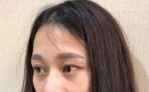 幻柔筆記：眼袋修復后氣質立現，怎么看都是青春靚麗！