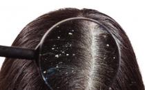 頭皮屑多是什么原因引起的 推薦6個有效去除頭皮屑的小妙招