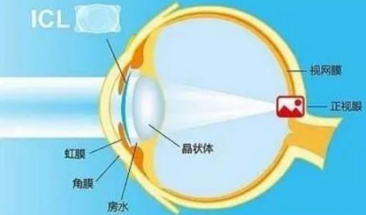 西安普瑞眼科醫(yī)院好嗎?戴眼鏡VS近視手術(shù),四個對比讓你不糾結(jié)